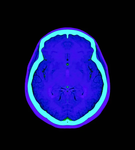 Барвиста Ангіографія Мозку Або Ста Мозку Осьовий Корональний Сагітальний Погляд — стокове фото