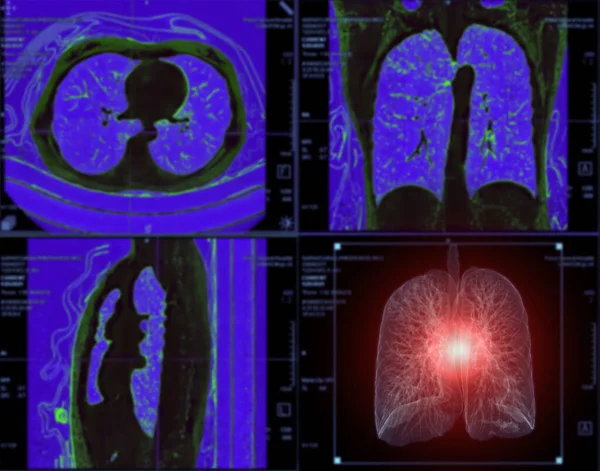 Mellkas Vagy Tüdő Renderelő Képének Szelektív Fókusza Monitoron Diagnosztizálásra Tbc — Stock Fotó