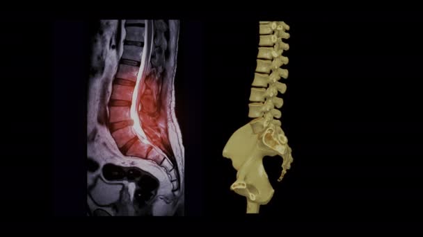 Lendenwirbelsäule Oder Wirbelsäule Rendering Für Rückenschmerzen Bei Patienten — Stockvideo