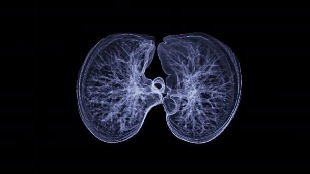 Akciğer Hastalığı Korona Virüsü Için Boyutlu Göğüs Akciğer Hazırlama — Stok video