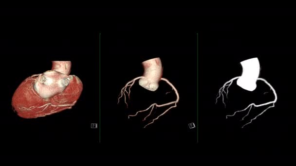 Cta Coronary Artery Renderização Mostrando Coração Com Vaso Coronary Artery — Vídeo de Stock