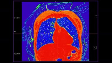 Kontrastlı medya koronal görüşlü CT Göğüs Akciğer hastalığı ve korona virüsü için füzyon rengi .