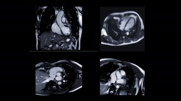 Mri Srdce Nebo Srdeční Mri Magnetická Rezonance Srdce Multiviewing Ukazuje — Stock video
