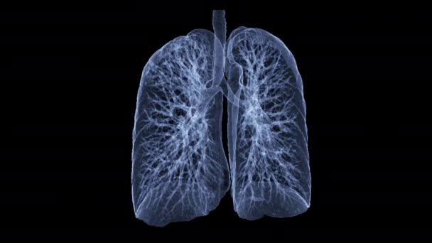 Chest Lung Rendering Image Turn Screen Diagnosis Tuberculosis Covid — Stock Video