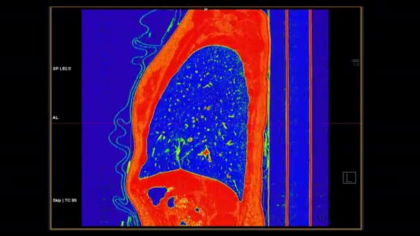 Chest Контрастними Засобами Масової Інформації Sagittal View Fusion Color Lung — стокове відео