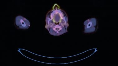 Tüm insan vücudunun pozitron emisyon tomografisi (PET CT) 3d görüntü kırmızı renk ton ekseni ameliyattan sonra tümörün nüksetmesini tespit etmek için.