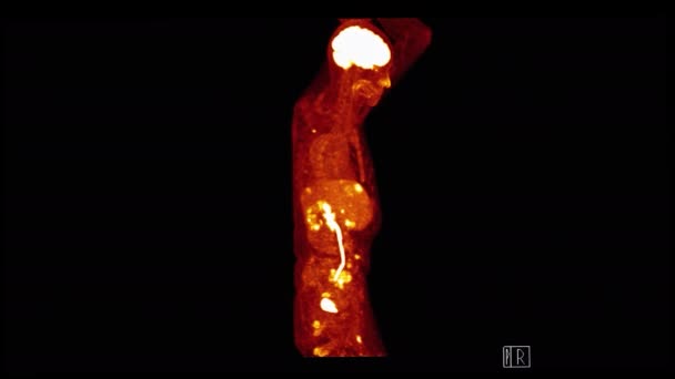 Pet Positron Emission Tomography Todo Corpo Humano Imagem Renderização Coronal — Vídeo de Stock