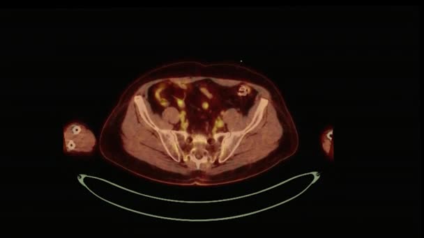 手術後の腫瘍再発を検出するための人体全体のPet 陽電子放出断層撮影法 3Dレンダリング画像赤い色のトーン軸 — ストック動画