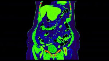  Tüm insan vücudunun pozitron emisyon tomografisi olan PET CT (Pozitron Emisyon Tomografisi) ameliyattan sonra tümörün nüksetmesi için 3d rengarenk görüntüleme tonu koronal görünümü.