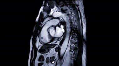 Sagittal görüşe göre kalp atışlarını kalp rahatsızlığını tespit etmek için kalp atışlarını gösteren MRI veya kalp MR 'ı (manyetik rezonans görüntüleme).