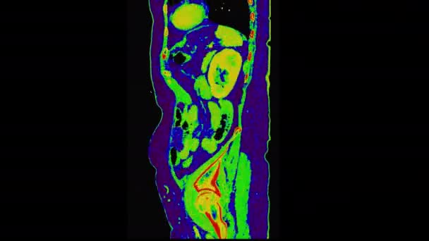 手術後の腫瘍再発を検出するために 人体全体のPet Positron Emission Tomography 3Dレンダリング画像カラフルなトーンの胃の視野 — ストック動画