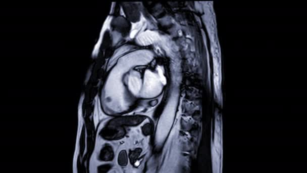 矢状图显示心脏跳动的Mri 磁共振成像 检测心脏病 — 图库视频影像