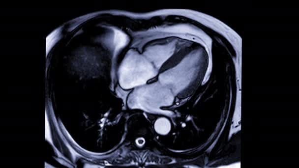 Mri Serca Lub Mri Serca Rezonans Magnetyczny Serca Widoku Długiej — Wideo stockowe