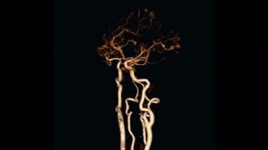 CTA Beyin veya beynin hesaplanmış tomografi anjiyografisi. Beynin serebral arterinin ekranda döndüğünü gösteren 3D görüntüleme..