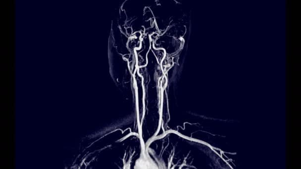 Arm Technique Cerveau Corotide Temps Vol Tof Angiographie Par Résonance — Video