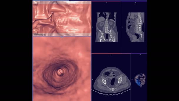 Ct结肠造影比较轴突 矢状和三维显示结肠内病变的影像检查 检查结肠癌检查结果 — 图库视频影像