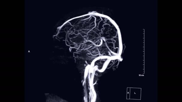 Mrv Venografía Cerebral Por Resonancia Magnética Vista Mip Del Cerebro — Vídeo de stock