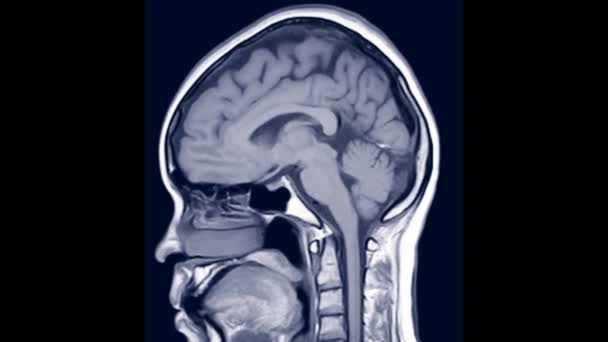 Мрт Мозга Сагиттального T1W Вид Показывающий Анатомические Мозга — стоковое видео
