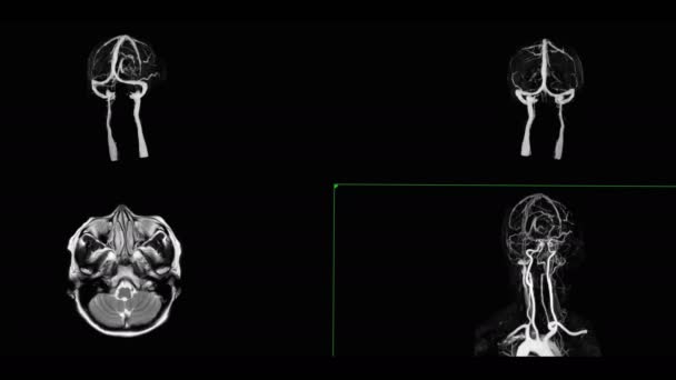 脑磁共振成像或磁共振成像扫描脑3D图像在屏幕上回转 以检测脑静脉引流中的异常 — 图库视频影像
