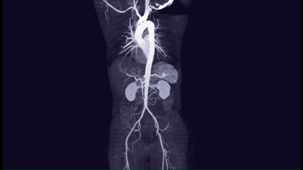 Cta Whole Aorta Mip Angiography Mip Technique Turn Screen Diagnosis — Stock Video