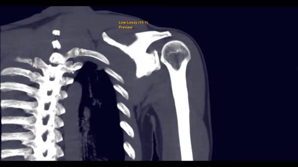 Computertomographie Darstellung Der Linken Schulter Mit Fraktur Des Oberarmkopfes — Stockvideo