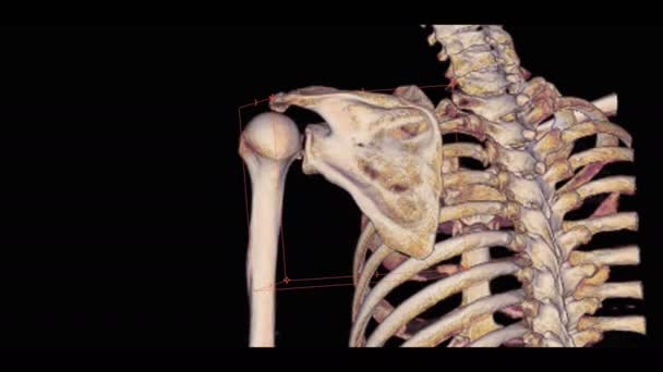 Tomografide Sol Omzun Görüntülemesi Kol Kemiğinin Kırık Olduğunu Gösteriyor — Stok video
