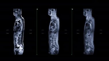 Gadolonyum kontrastlı MRI taraması omurga sıkıştırma omuriliğini gösteriyor. .