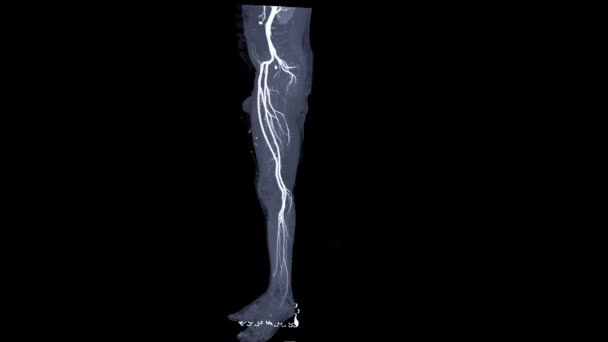 Cta Femorális Artéria Runn Mip Módszer Viszont Képernyőn Kimutatására Perifériás — Stock videók