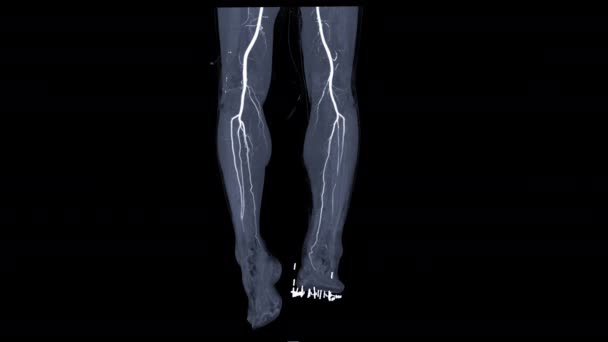 Cta Arteria Femoral Escurrió Fuera Del Método Mip Dar Vuelta — Vídeos de Stock