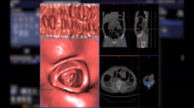 Tomografi, Axial, Coronal, sagittal ve kolorektal kanseri taramak için intra kolon gösteren 3 boyutlu filmleri karşılaştırır. Kolon kanserinin taramasını kontrol et.