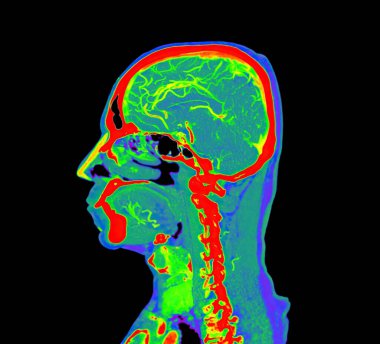 Renkli beyin anjiyografisi ya da CTA beyin Sagittal görüşü. Kesme yolu.