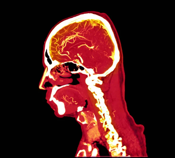 Colorido Angiografía Por Del Cerebro Cta Vista Sagital Del Cerebro —  Fotos de Stock