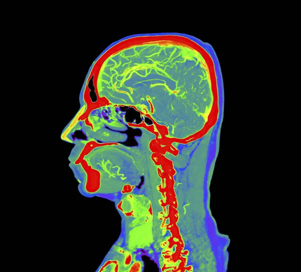 Colorful Angiography Brain Cta Brain Sagittal View Clipping Path — Stock Photo, Image