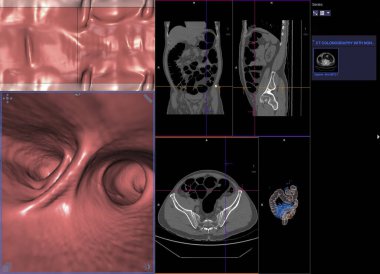 Kalın bağırsak kanseri teşhisi için ekranda Kolon Eksen Görünümü vs Coronal Görünüm ve 3D görüntüleme tomografisi veya CT Taraması.