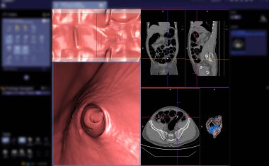 Kalın bağırsak kanseri teşhisi için ekranda Kolon Eksen Görünümü vs Coronal Görünüm ve 3D görüntüleme tomografisi veya CT Taraması.