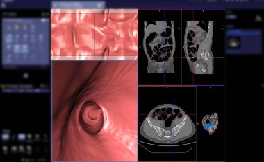 CT colonography or CT Scan of Colon axial view vs Coronal view and 3D rendering image on the screen for diagnosis large bowel cancer. clipart
