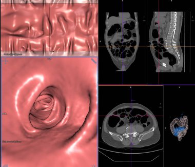 Kalın bağırsak kanseri teşhisi için ekranda Kolon Eksen Görünümü vs Coronal Görünüm ve 3D görüntüleme tomografisi veya CT Taraması.