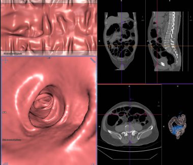 CT colonography or CT Scan of Colon axial view vs Coronal view and 3D rendering image on the screen for diagnosis large bowel cancer. clipart