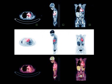 Tüm vücudun PET taraması görüntüsü Axial, Coronal ve Sagittal düzlemlerde kanser tekrarını tespit etmek için. tıbbi teknoloji kavramı.