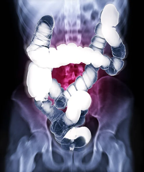 Selective focus of barium enema image or x-ray image of large intestine isolated on blurred abdomen x-ray backgroung  showing anatomical of colon for detect Colon cancer . Clipping path.