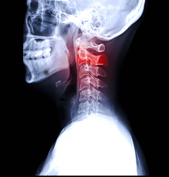 X-ray C-spine or x-ray image of Cervical spine lateral view for diagnostic intervertebral disc herniation and Spondylosis