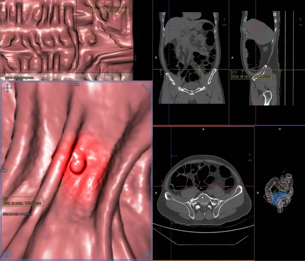 大腸がんの診断画面上の結腸軸方向の画像と大腸がんの診断画面上のコロナビューと3Dレンダリング画像のCt大腸がんまたはCtスキャン — ストック写真