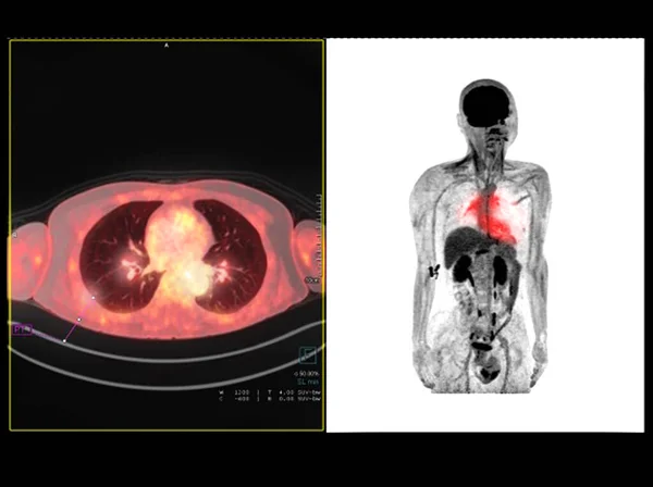 Pet Imagem Varredura Tórax Tórax Comparação Axial Coronal Para Detectar — Fotografia de Stock