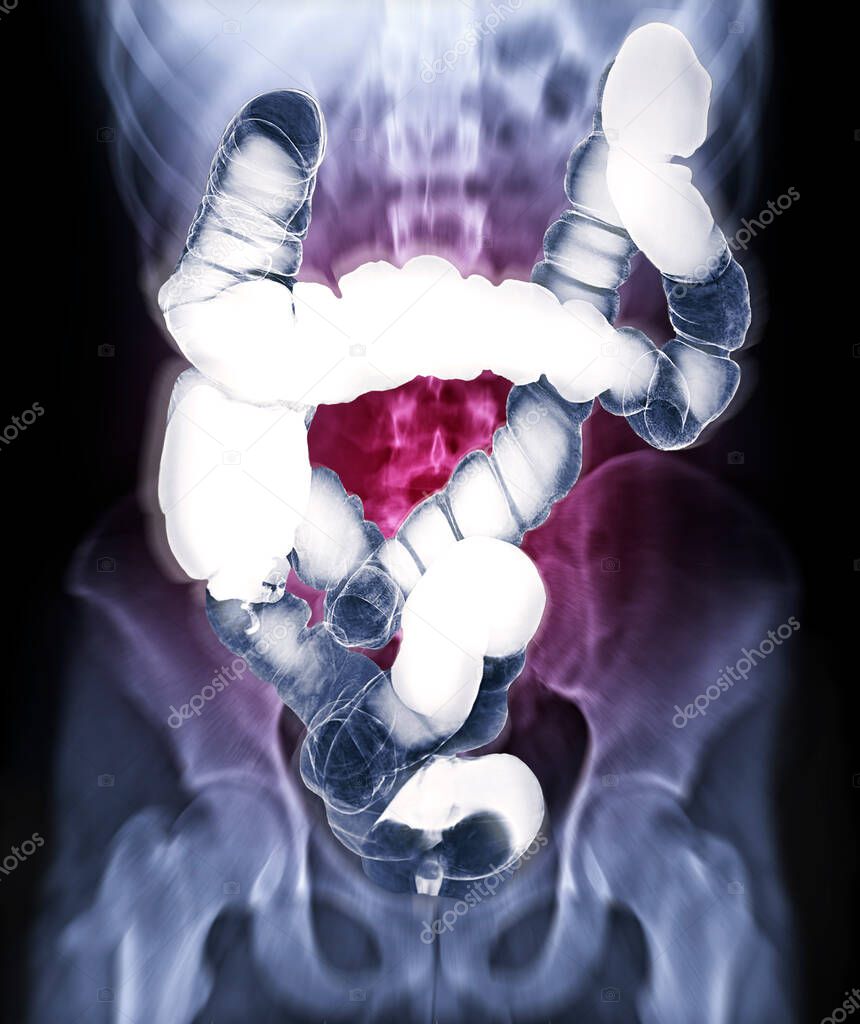 Selective focus of barium enema image or x-ray image of large intestine isolated on blurred abdomen x-ray backgroung  showing anatomical of colon for detect Colon cancer . Clipping path.