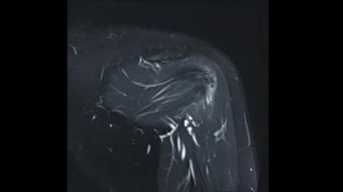 Omzundaki MRI eklemlerini ya da omuz eklemlerindeki manyetik rezonans görüntülerini artrit teşhisi için T2W FS ile gözyaşı ve immünasyon için karşılaştır.