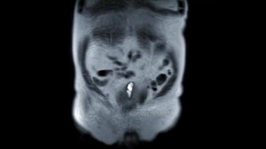 MRI prostat bezi. Yaşlı erkeklerde prostat kanseri hücresi teşhisi için koronal T2W görünümü..
