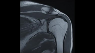 MRI omuz eklemi veya omuz eklemli manyetik rezonans görüntüleme tanısı için Omuz eklemsel PDW artrit ve gözyaşı ve imintion dahil.
