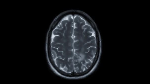 Mri Brain Axial T2W Tecnica Rilevare Malattia Ictus — Video Stock