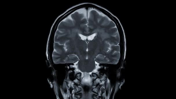 Mri Cérebro Coronal T2W Técnica Para Detectar Doença Acidente Vascular — Vídeo de Stock