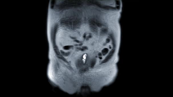 Glándula Prostática Coronal T2W Ver Para Diagnóstico Células Cáncer Próstata — Vídeo de stock